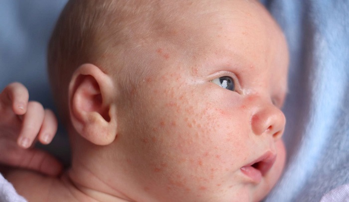 Skin Spots in Children and Adults: Causes and Treatment