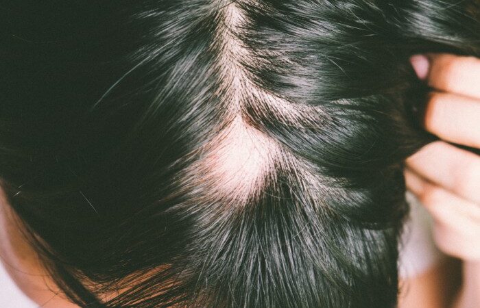 Scarring Alopecia: Alopecia That Can Be Irreversible